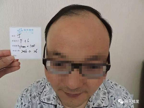 超大额头！植发3010单位9月救出好形象！超帅！