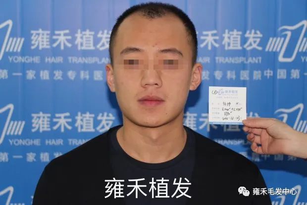 他很年轻也很秃跨省植发3790只为未来的孩子一个年轻爸爸