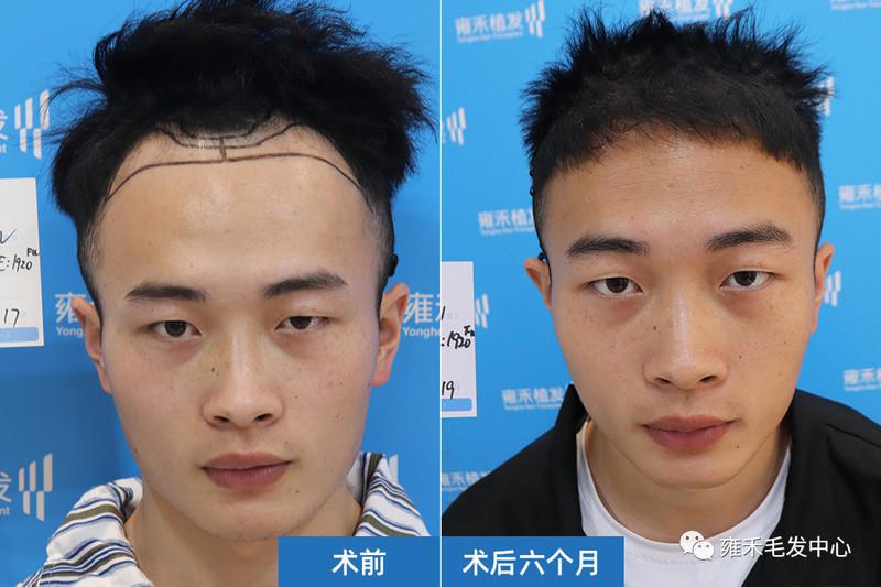 泉州植发雍禾为小黄种植2584单位头发也能种植