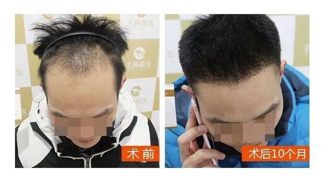 90小伙严重脱发去植发10个月形象大改变