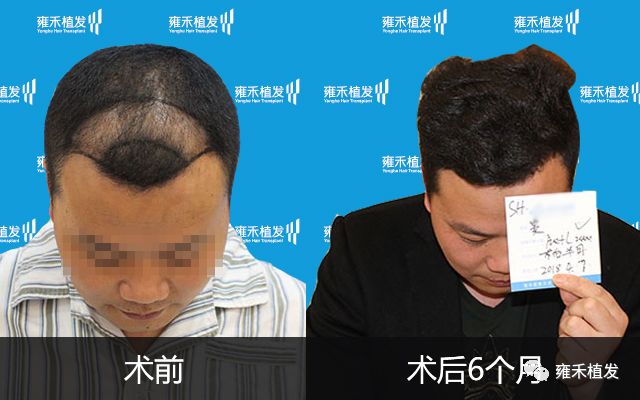 发际线后退形象差上海雍禾为窦先生种植2600单位