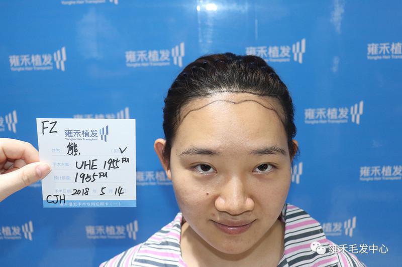 福州有哪些植发比较靠谱发际线变高不知道植发
