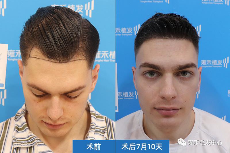 乌克兰植发帅哥秃了一点在中国植发1050毛囊