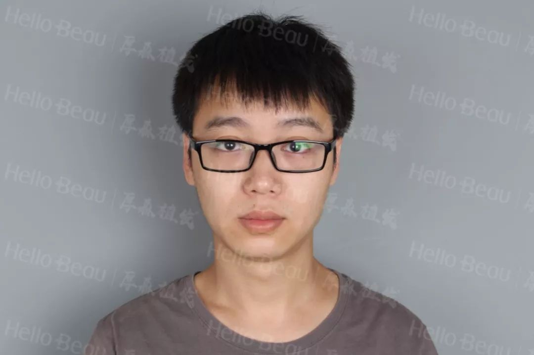 严重脱发才植发？他脱发一点点当机立断要植发