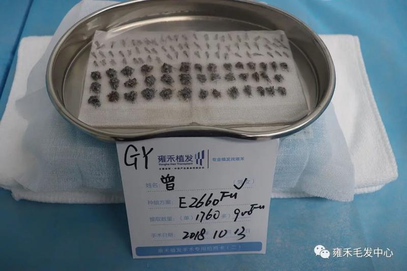 舞蹈老师种植发际线又眉毛种植，植发2660单位1年倍儿帅