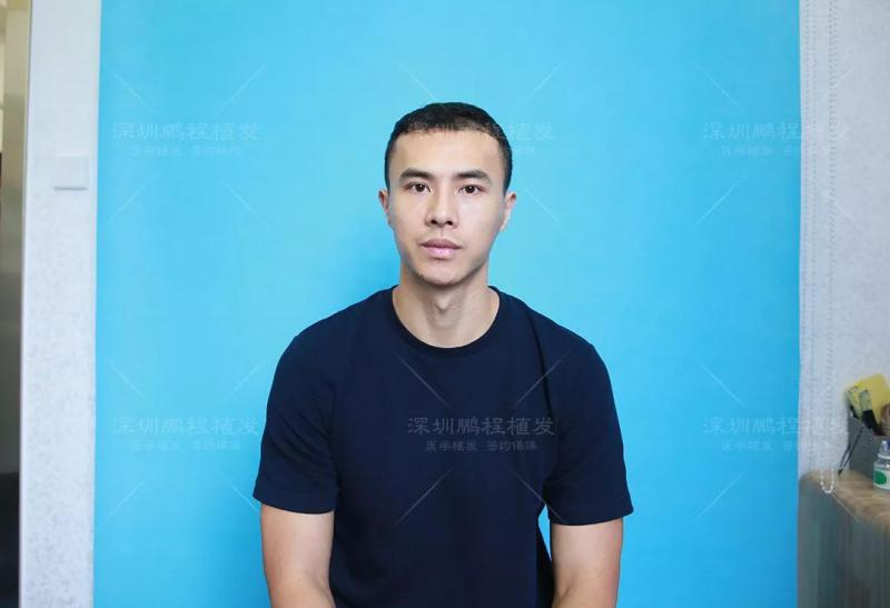 植发案例发际线后移、头顶光秃，别说你不想改变！