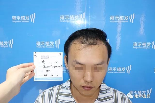 对植发放心不下一直拖着不植发宁愿秃着头不愿进医院
