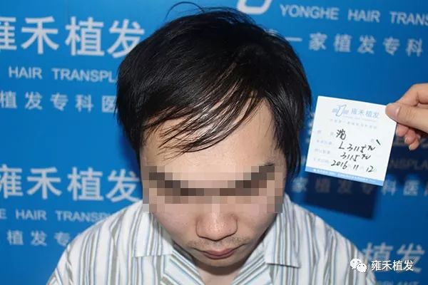 云南昆明沈先生脱发比较严重发际线种植提倡FUE