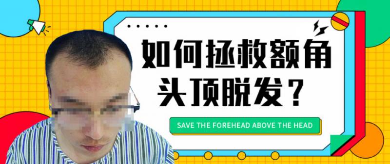 为什么只有前额和头顶会脱发？如何治疗？