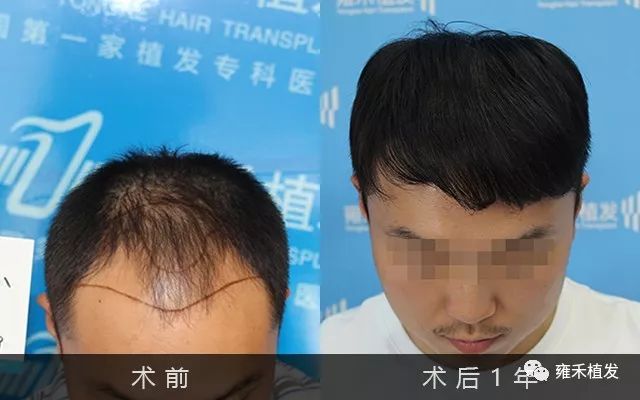 郑州雍禾为小宋植发2965单位贷款植发男神形象回来了