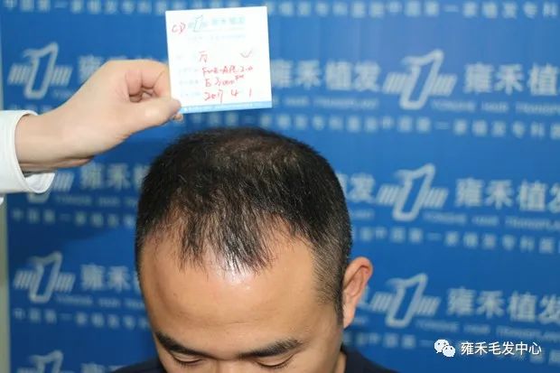 他从了解植发到手术考虑15个月最后植发3600单位