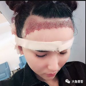 小姐姐发际线植发五个月分享