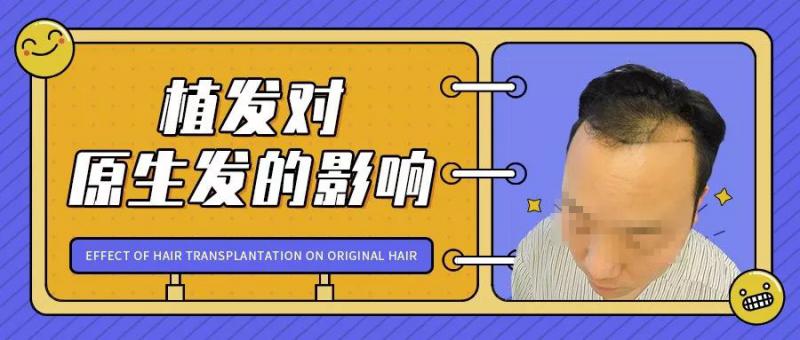 植发会影响原生头发的生长吗？