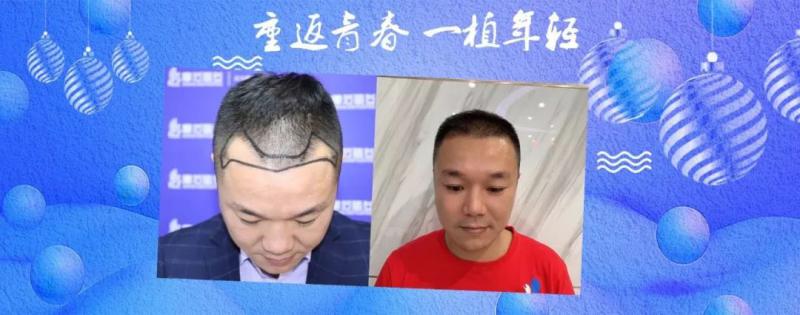 通过朋友了解到了摩范植发这才知道还有植发这个神级操作