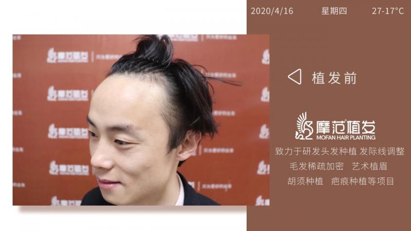 植发后发线生长自然浓密年轻10岁帅气有型