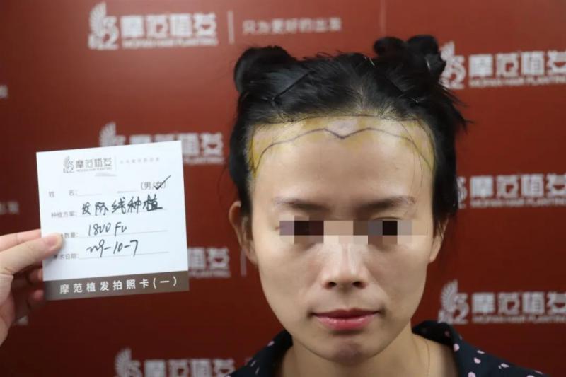 19年植发的小可爱头发长好了吗？