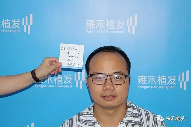 他脱发属于脂溢性脱发头发特别油长沙种头发2180单位