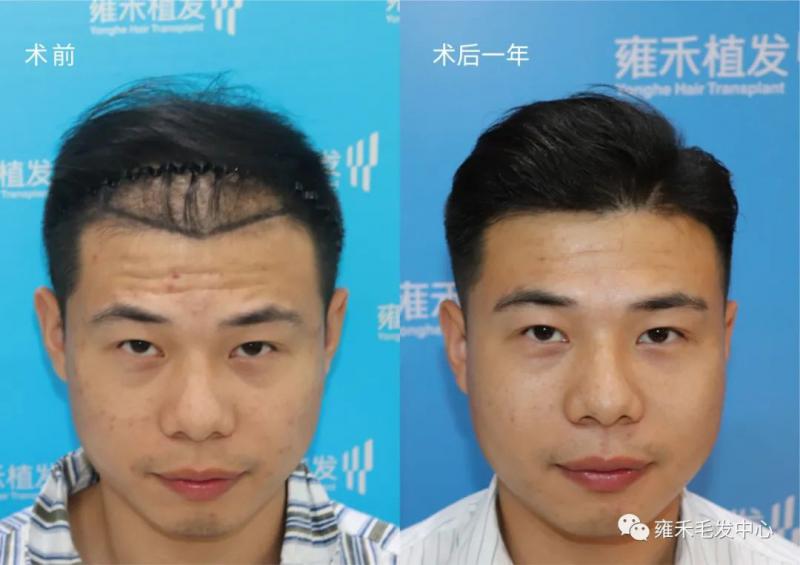 90后熬夜打游戏秃了植发3950单位1年后效果
