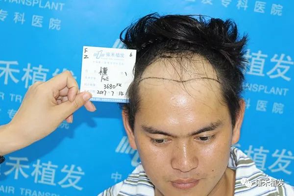 脱发自卑怕照相，植发3750单位变帅迷上自拍！