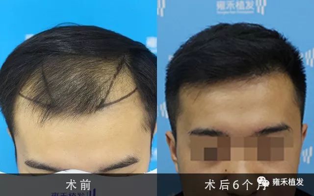 太原不理发植发2138单位6个月茂密秀发发际线下移