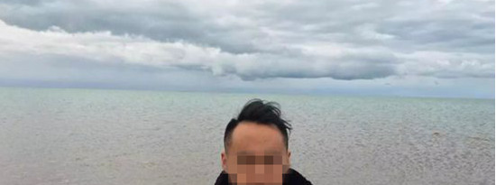 植发失败后我在科发源二次修复植发成帅哥