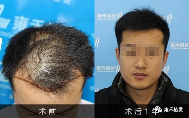 李先生来郑州雍禾植发医院种头发老婆是跟着来的