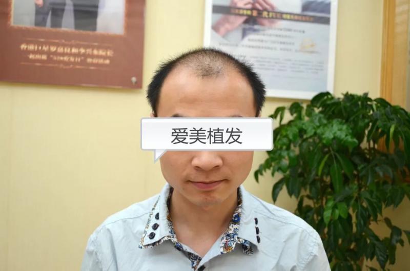 未老先秃植发后重返年轻！
