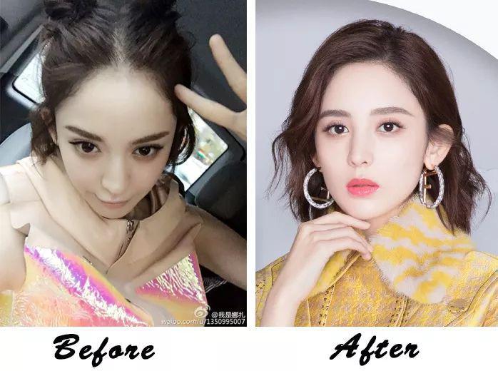 发际线种植不仅能美化额头还能修饰脸型改变发际线