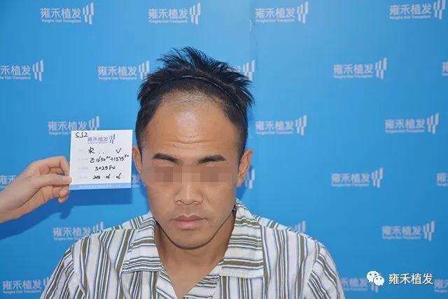 25岁秃得像35岁要找女朋友着急赶紧植发3054单位