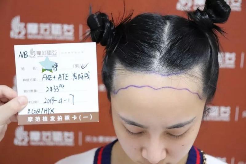 美丽再出发小静发际线种植她自己也蛮喜欢