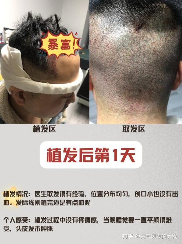 医学硕士植发辛酸史，植发后1-375天的恢复全记录
