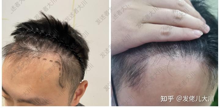 植发有用吗？哪家医院好？三大家优缺点对比,哪家最坑？哪家做得最好？