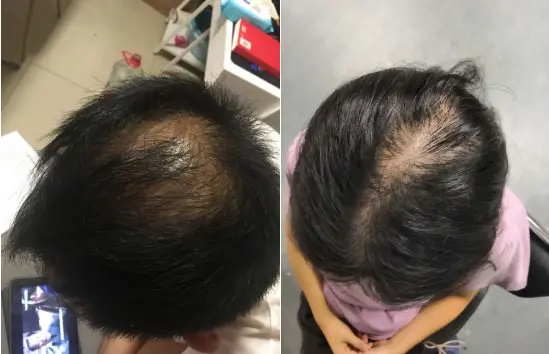 头顶脱发严重，稀疏见头皮马上秃顶？3种方法教你恢复发量