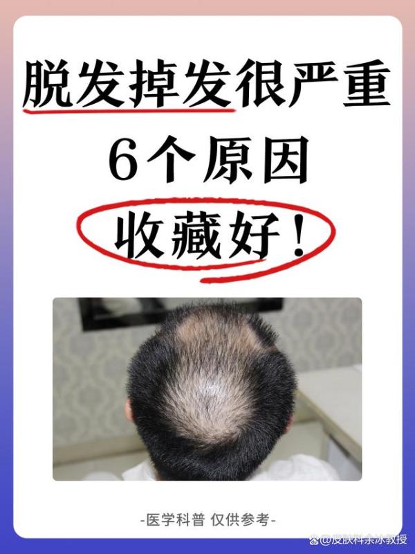 脱发掉发很严重，6个原因收藏好