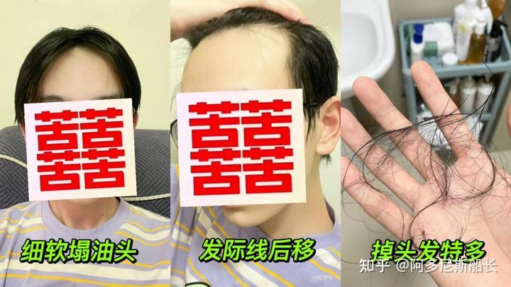 防脱洗发水真的有用吗？有没有靠谱的防脱洗发水推荐？