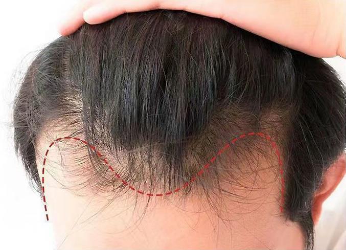 什么洗发水能防止脱发，让头发再生？防脱发网评排行榜