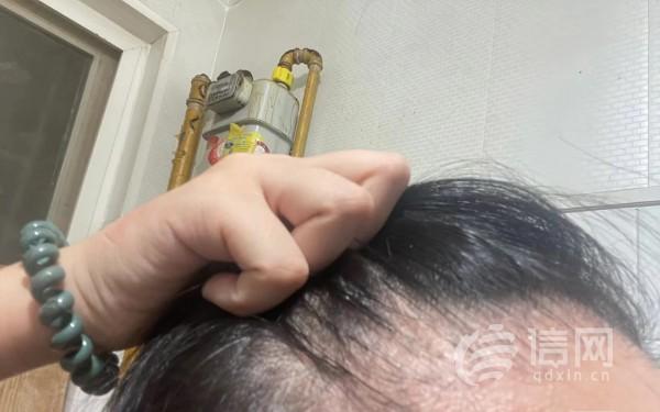 在熙朵植发补发际线效果不明显 成活率是否合格双方争执不下