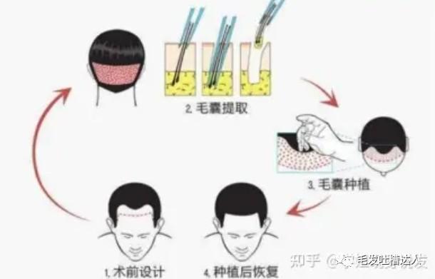 植发的具体流程是怎样的？