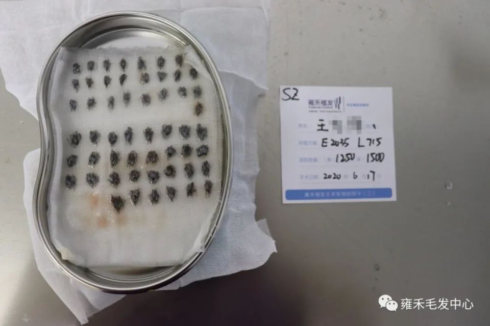 小帅哥发际高植发2750单位，术后还用这样两种药