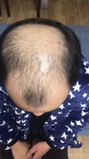 不吹不黑，客观讲一下我的植发感受