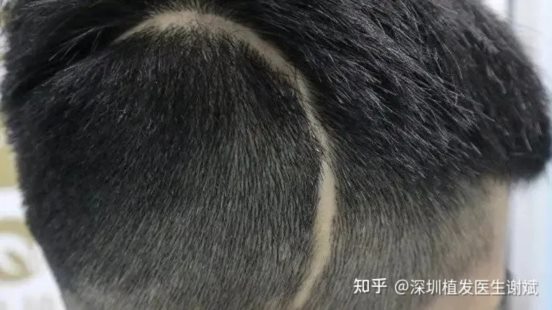头上有疤痕可以植发吗？疤痕植发价格怎么样？