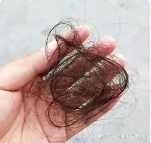 秋冬交替大把脱发掉发，这是正常的掉发还是病理性的脱发？