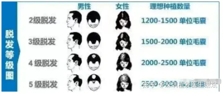 2023植发2000毛囊、3000毛囊要多少钱？分享植发价格参考