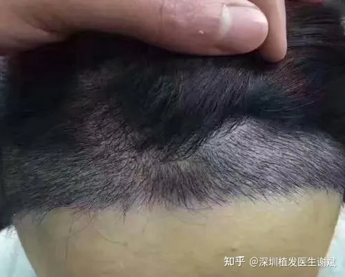 最好的植发医院有哪些？千万不要被骗了！植发选择攻略来了！