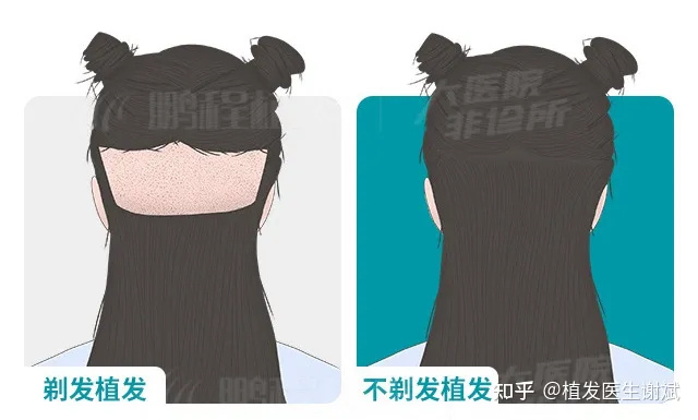 我想植发，选不剃发还是剃发植发好？哪种植发效果好？