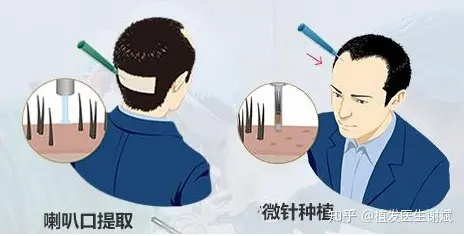 脱发面积不断扩大！难道非要植发吗？现在植发过年前能恢复吗？