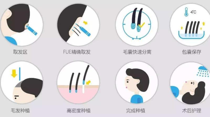 植发了解有多少?植发只需要做一次吗?