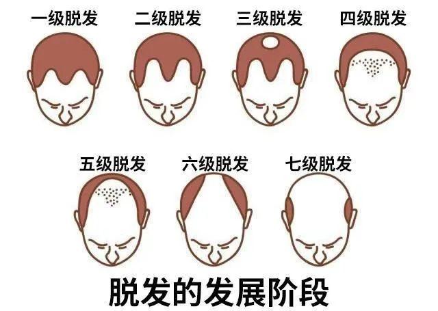 植发价格是不是很贵？植发到底需要多少钱？