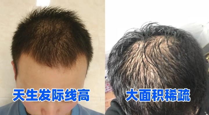 植发真的靠谱吗？植发医院怎么选？