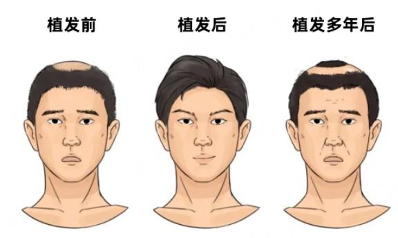 植发后笑死人！这些脱发千万别植发！